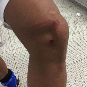 O joelho de Ramon Ábila ficou assim no lance com Cássio (Foto: Divulgação/Cruzeiro)
