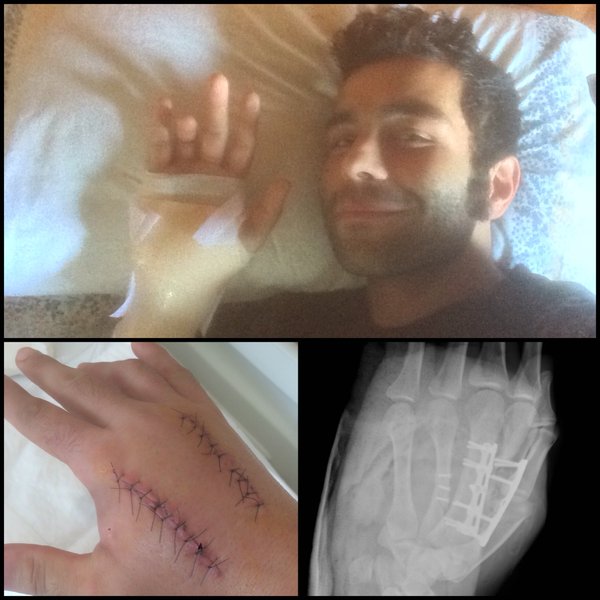 The damage Petrucci's hand has sustained | Photo: Twitter/@Petrux9