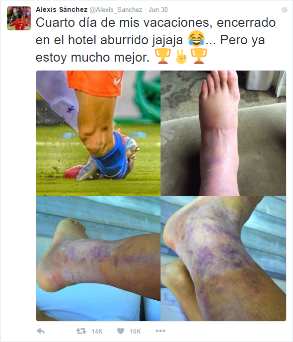 The damage done to Sanchez's left ankle | Photo: Twitter - @Alexis_Sanchez