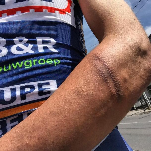 Estado de su brazo tras el ataque | Foto: Facebook - Yoann Offredo