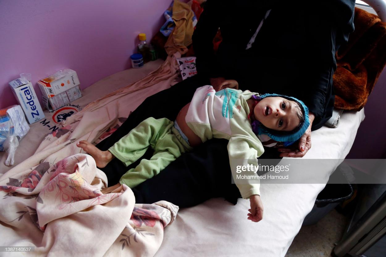 A young child is dying of malnutrition in war-torn Yemen: Mohammed Hamoud/Getty Images