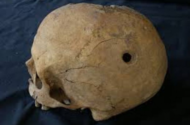 Trepanación: cirugía en la Prehistoria