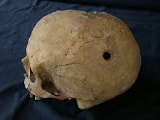 Trepanación: cirugía en la Prehistoria